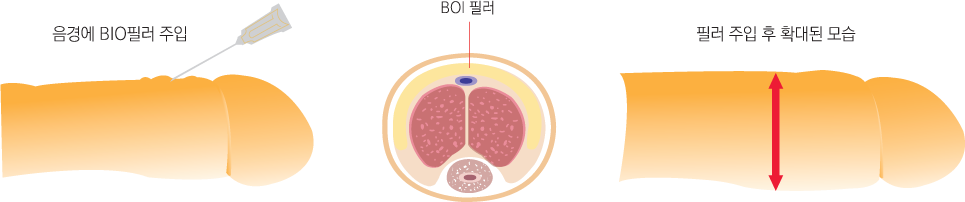 무수술 필러음경확대