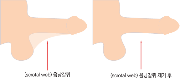 음낭갈퀴제거술